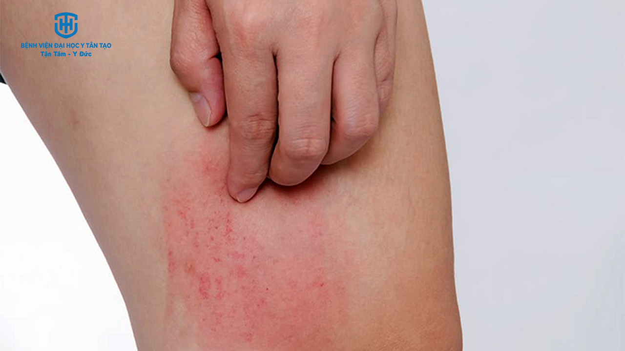 Trời lạnh bị ngứa: Nguyên nhân và cách khắc phục