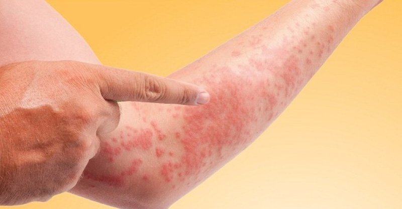 Trời lạnh bị ngứa tay chân: Nguyên nhân và cách khắc phục