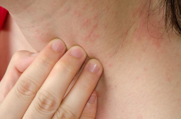 Trời nóng nổi mẩn ngứa: Nguyên nhân và cách khắc phục hiệu quả