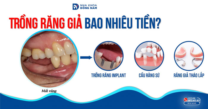 Trồng 1 cái răng bao nhiêu tiền? Gallery 2