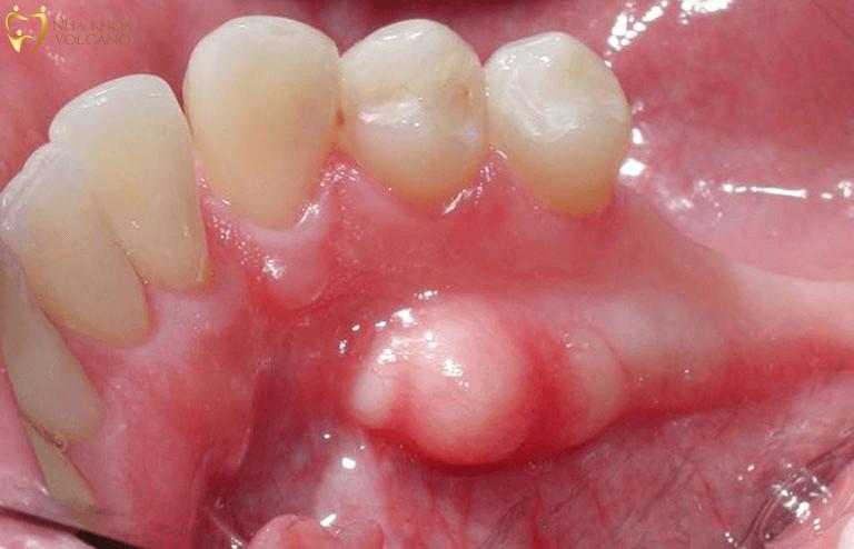 Trong Miệng Nổi Cục Cứng: Nguyên Nhân và Cách Xử Lý