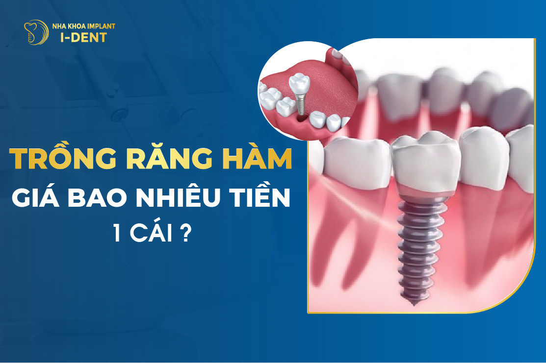 Trồng Răng Giả Bao Nhiêu 1 Chiếc?