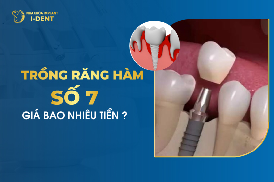 Trồng Răng Số 7 Hàm Dưới Bao Nhiêu Tiền?