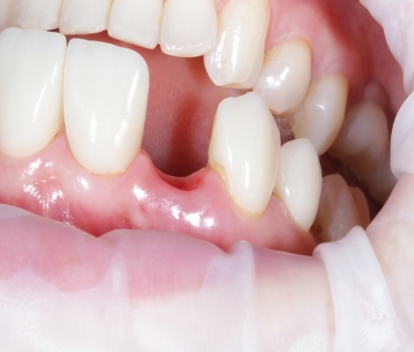 Trồng răng sứ không có chân răng giả giá bao nhiêu?