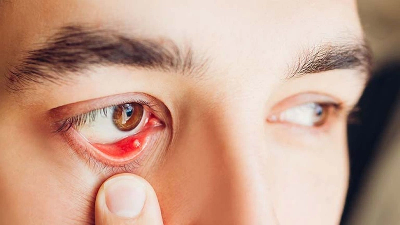 Tự Nhiên Bị Đau Bọng Mắt: Nguyên Nhân và Cách Khắc Phục