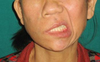 Tự nhiên bị méo miệng: Nguyên nhân và cách xử trí