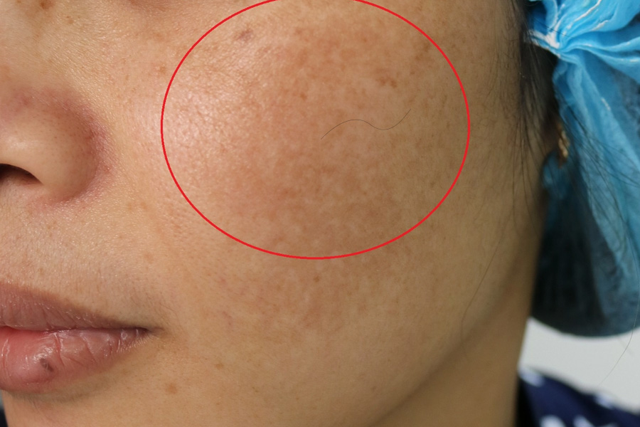 Tự Nhiên Mọc Lông Đen Trên Mặt: Nguyên Nhân Và Cách Khắc Phục