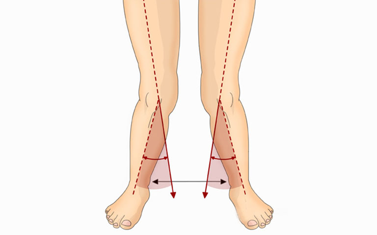 Tướng Phụ Nữ Chân Đi Chữ Bát