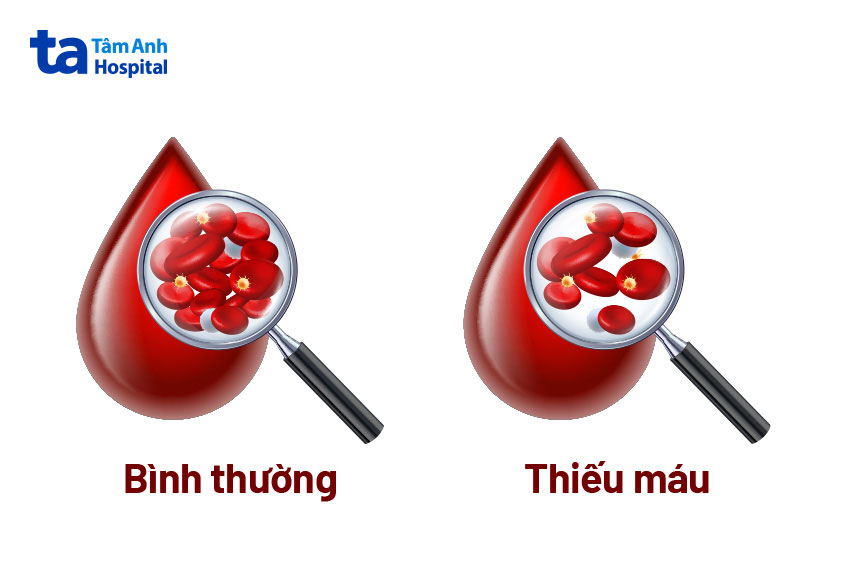 Tuột Máu Là Gì?