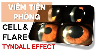 Tyndall tiền phòng là gì Gallery 2