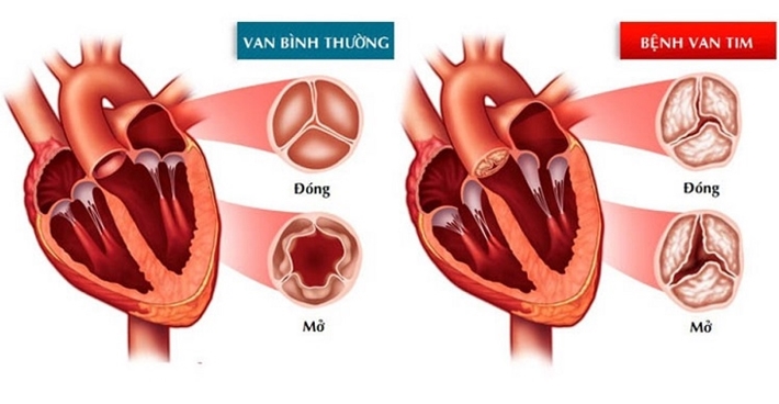 Heart Valve Disease Gallery 1