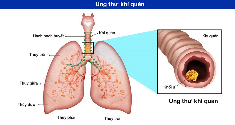 Ung thư phế quản và phổi