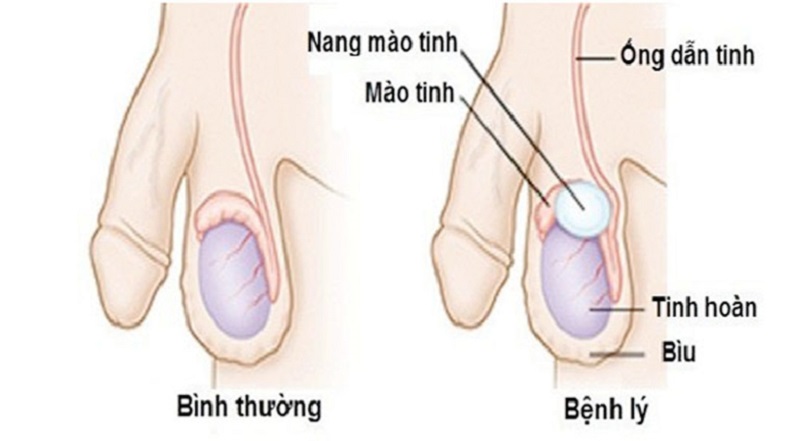 U Mào Tinh Hoàn