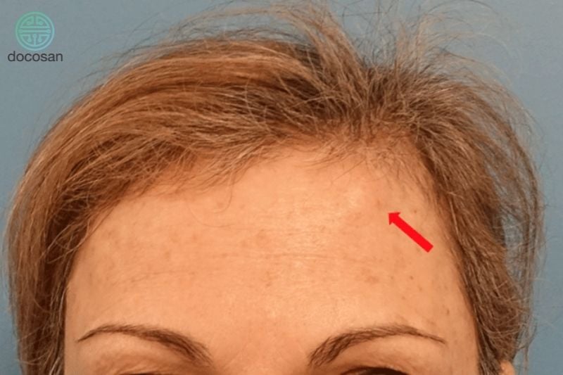 U Mỡ Ở Trán: Nguyên Nhân, Triệu Chứng Và Cách Điều Trị