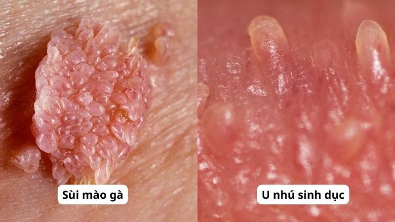 U nhú gai là gì?