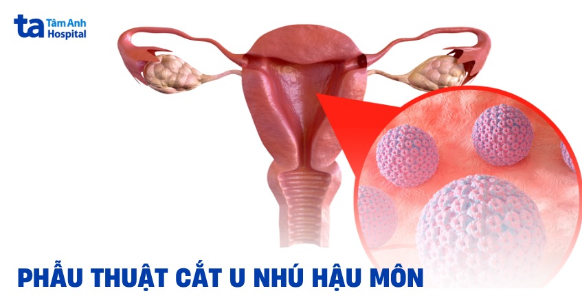 U nhú hậu môn