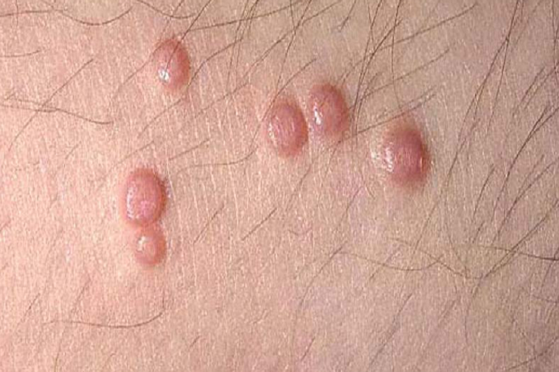 U Nhú Lành Tính Là Gì? Nguyên Nhân, Triệu Chứng Và Cách Điều Trị
