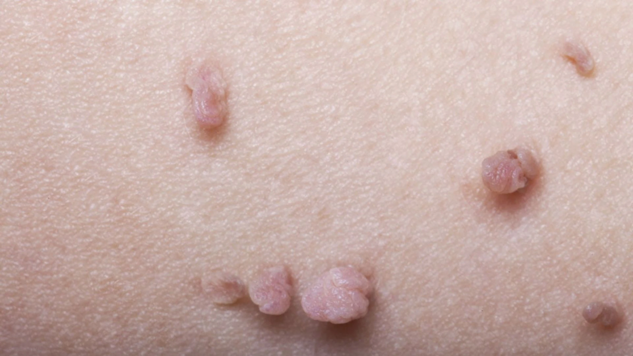 U Nhú Trên Da: Nguyên Nhân, Triệu Chứng Và Cách Điều Trị