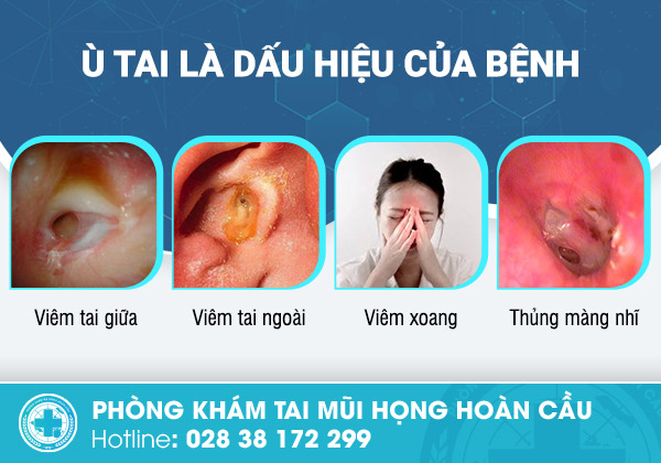 Ù tai là triệu chứng gì?