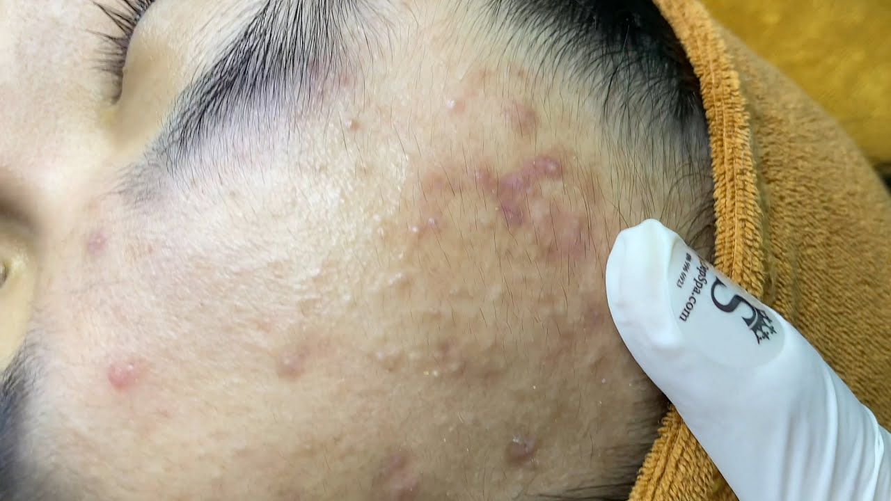 Hidden Acne: Causes, Treatment, and Prevention Gallery 1