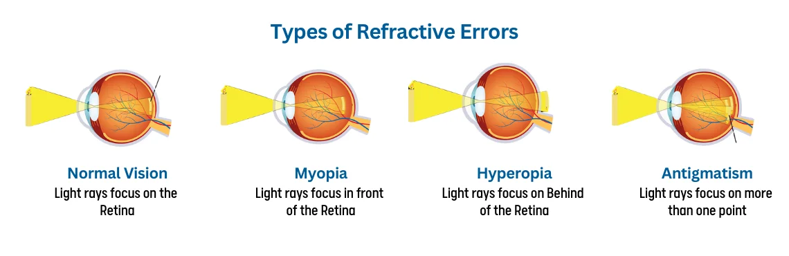 Refractive Errors in English Gallery 1