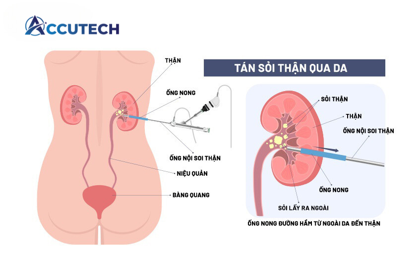 Tán sỏi qua da hết bao nhiêu tiền? Gallery 2