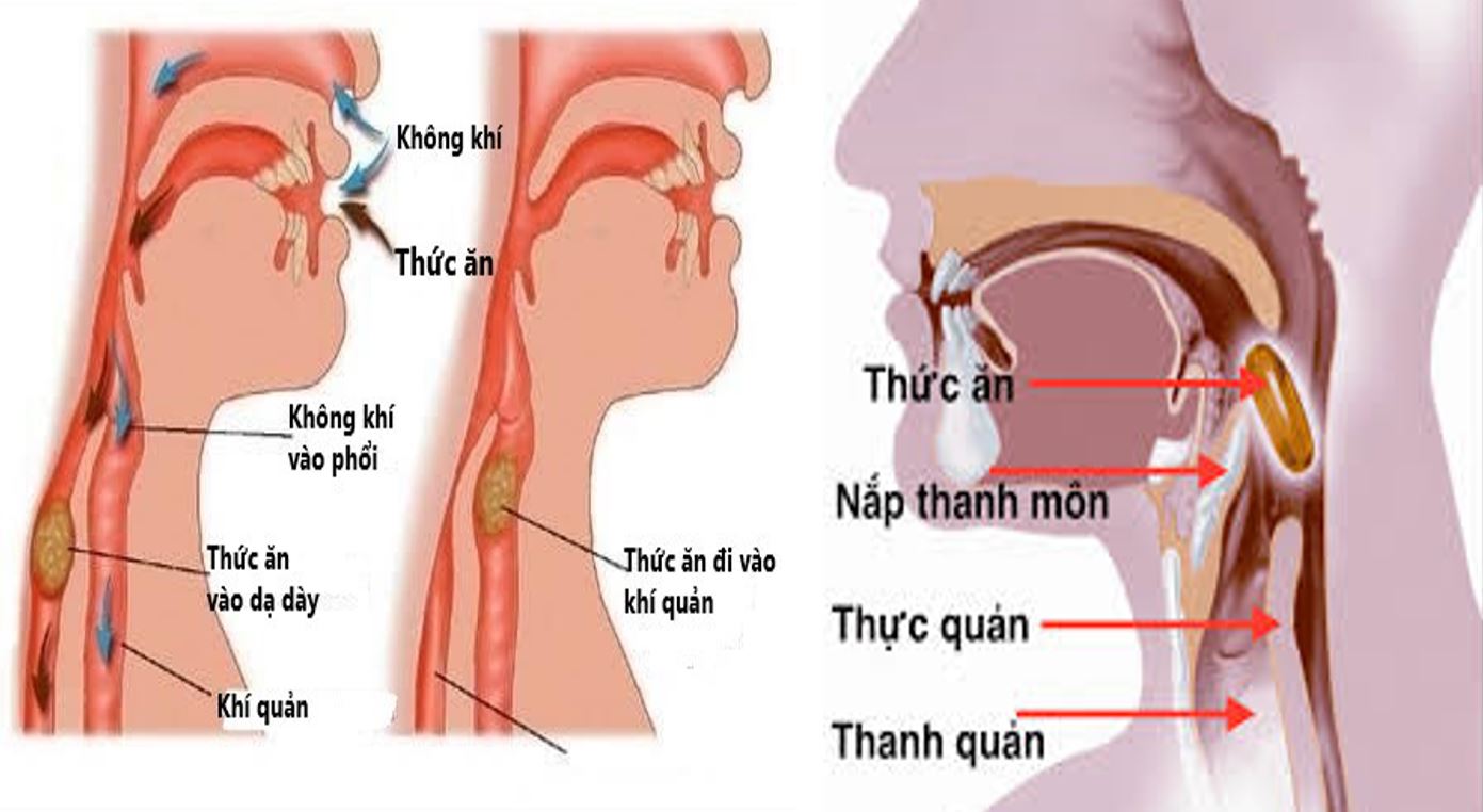 Uống nước hay bị sặc là bệnh gì?