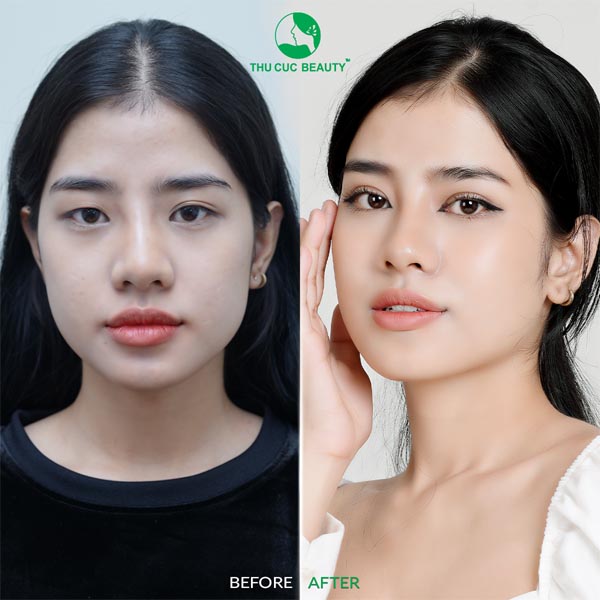 Nhấn Mí Thu Cúc: Phương Pháp Làm Đẹp Mắt An Toàn và Hiệu Quả Gallery 1