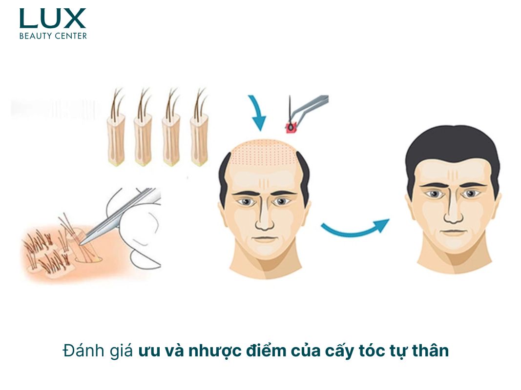 Cấy tóc tự thân là gì? Gallery 1