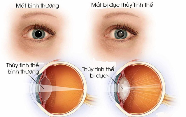 Thay Thủy Tinh Thể Mắt: Giải Pháp Khắc Phục Tật Khúc Xạ Hiệu Quả Gallery 2