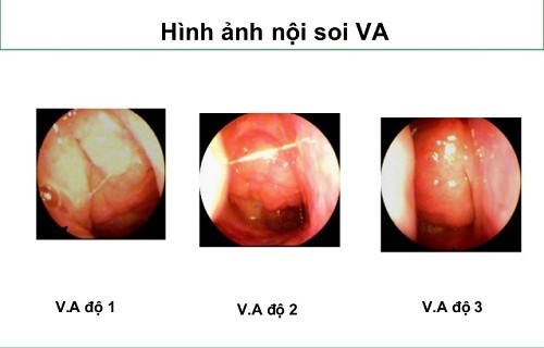 Vã Quá Là Gì? Giải Đáp Cảm Giác "Vã Quá"