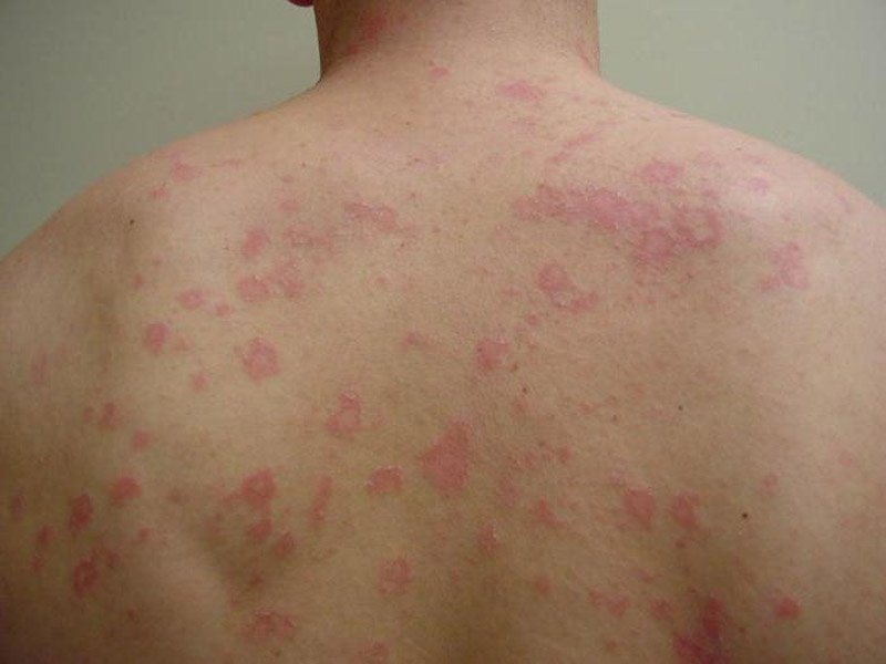 Vẩy phấn hồng bao lâu thì khỏi?