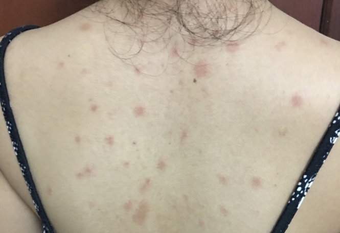 Vảy phấn hồng có tự khỏi không?