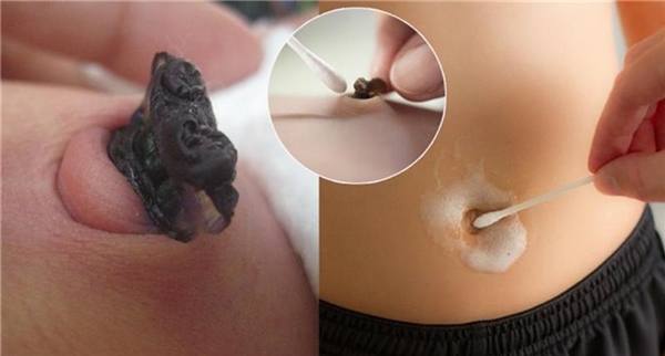 Vệ Sinh Lỗ Rốn Đúng Cách, Tránh Viêm Nhiễm
