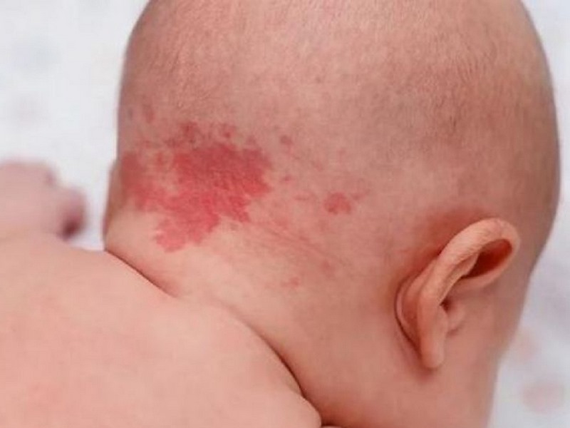 Vết bớt đỏ sau gáy có ý nghĩa gì?