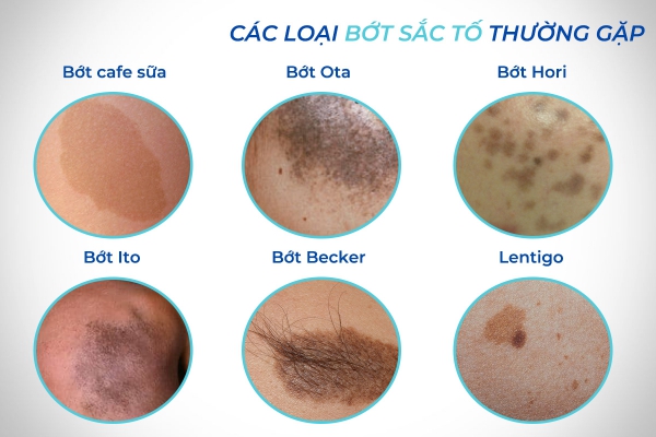Vết bớt màu trắng có ý nghĩa gì? Gallery 2