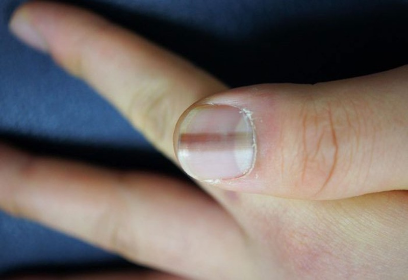 Vệt đen ở móng tay: Nguyên nhân và cách xử lý