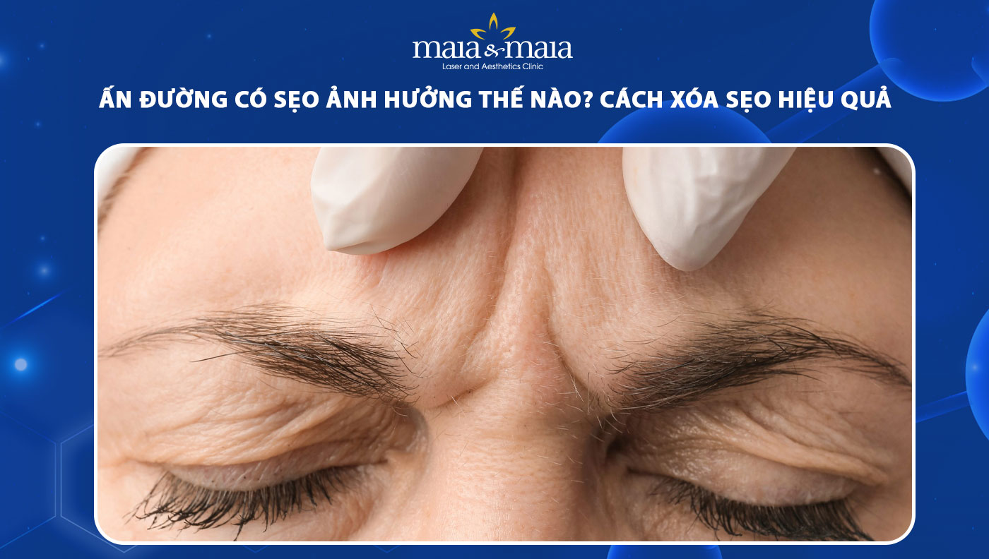 Vết Sẹo Giữa Hai Lông Mày: Nguyên Nhân, Điều Trị và Phòng Ngừa