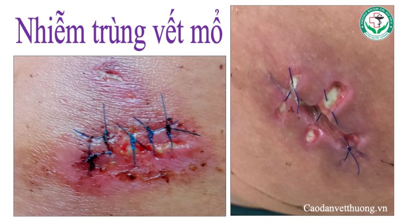 Vết Thương Sâu Hở Miệng: Nguyên Nhân, Cách Xử Trí Và Phòng Ngừa