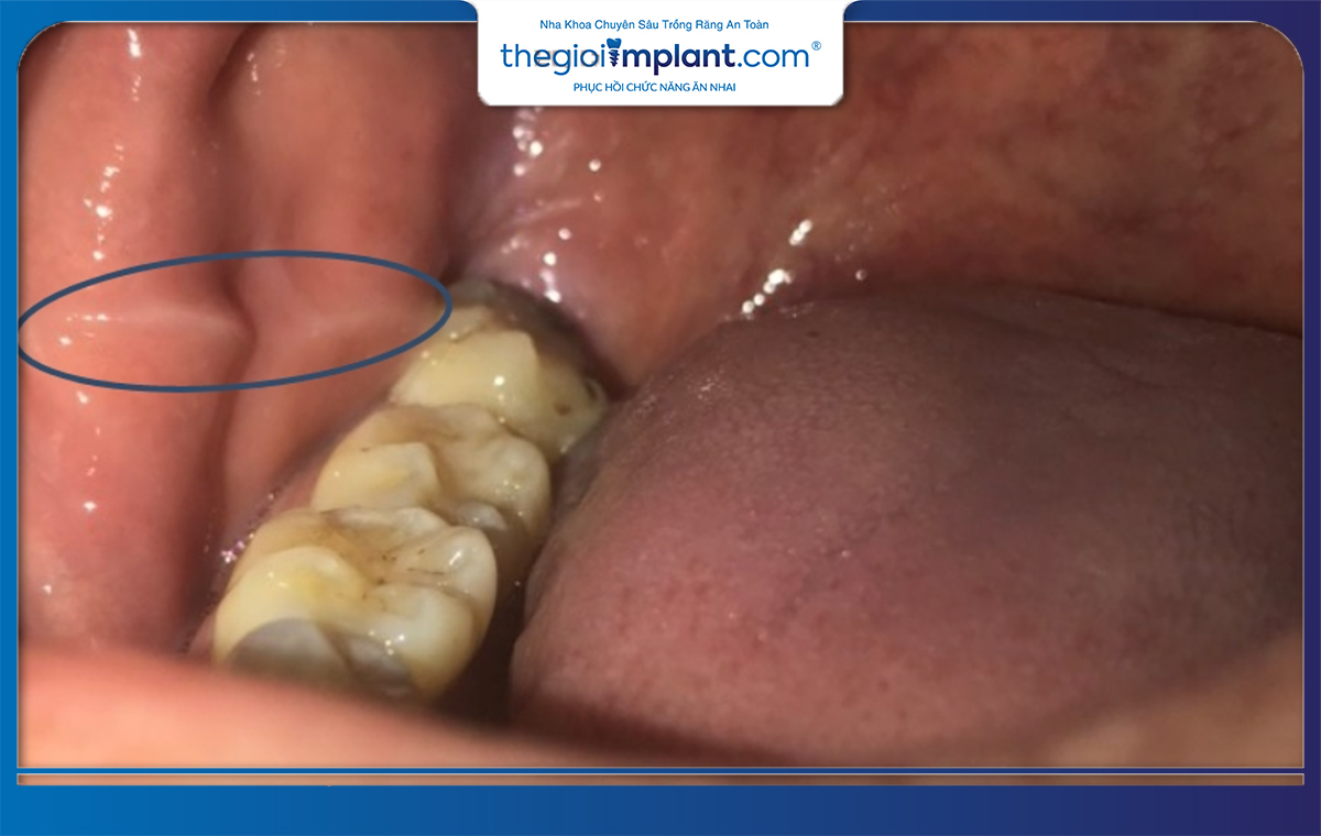 Vết Trắng Dài Hai Bên Má Trong Là Gì? Nguyên Nhân Và Cách Điều Trị