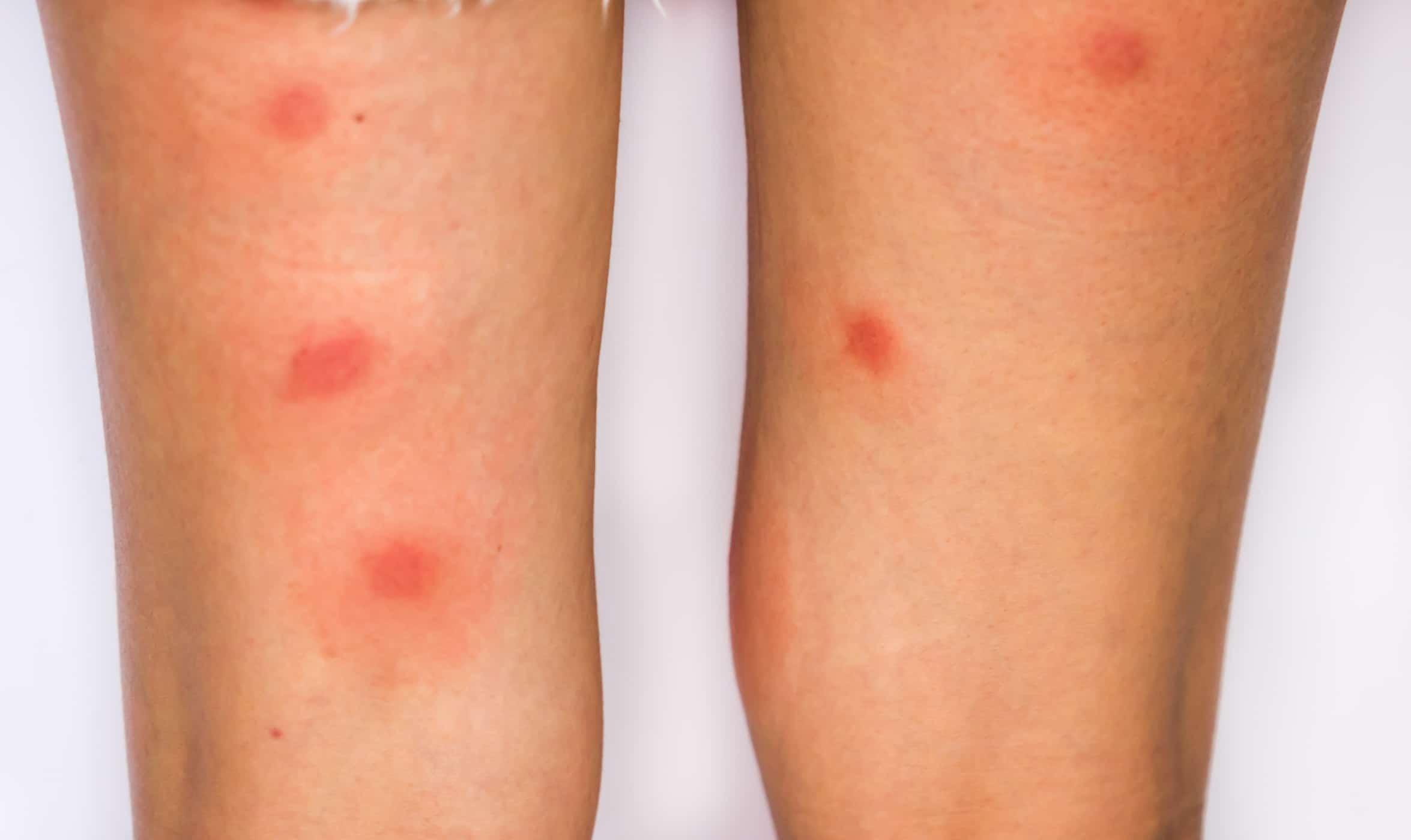 Vết Ve Chó Cắn: Nguyên Nhân, Triệu Chứng và Cách Xử Lý