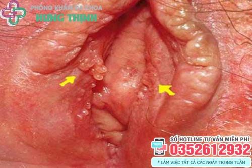Gai Sinh Dục Thường Mọc Ở Đâu? Gallery 1