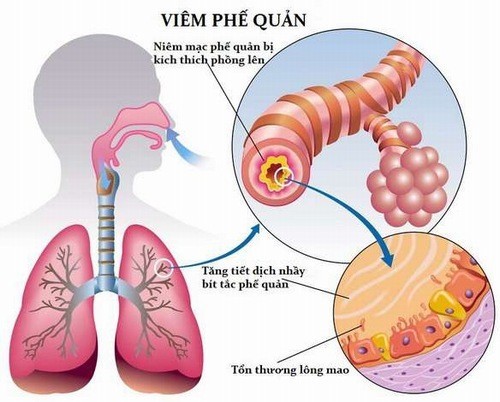 Viêm Phế Quản Co Thắt