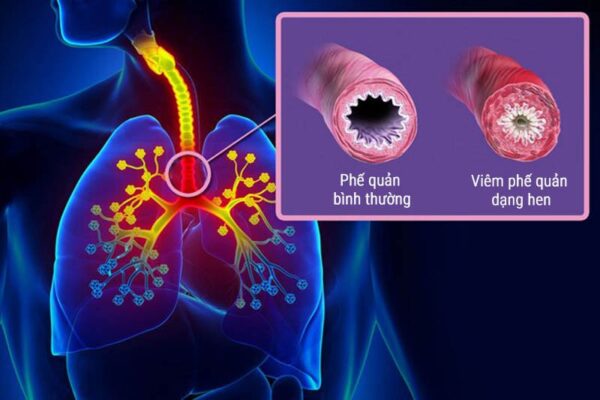 Viêm Phế Quản Dạng Hen Ở Trẻ Em