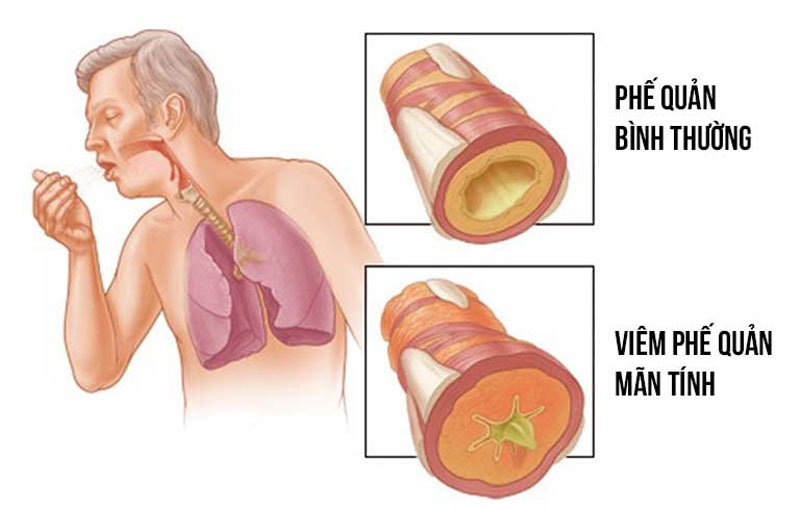 Viêm Phế Quản Mạn Tính Có Nguy Hiểm Không?