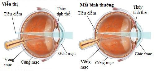 Các Tật Của Mắt Và Cách Khắc Phục Gallery 2