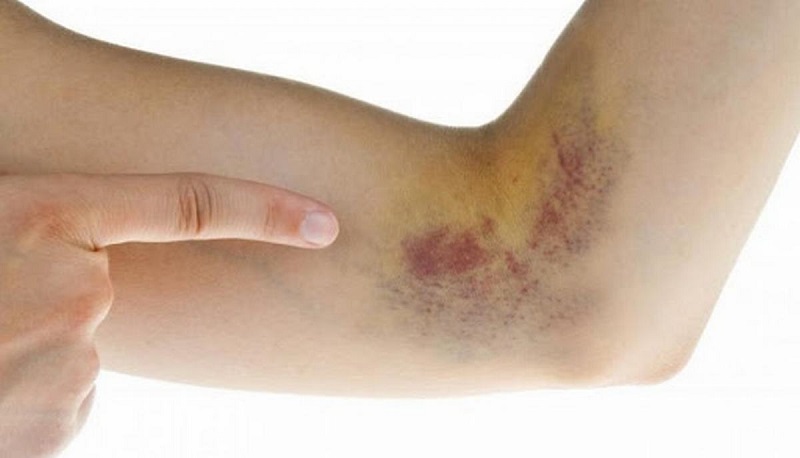 Vỡ Vein Là Gì?