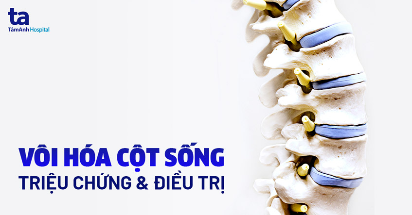 Vôi hóa cột sống