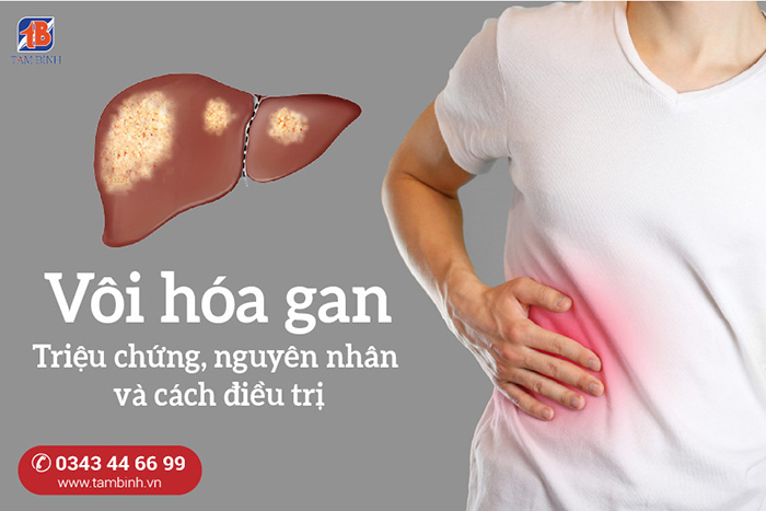 Vôi hóa gan có chữa được không?