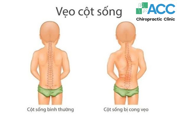 Vòng Eo Bị Lệch: Nguyên Nhân, Triệu Chứng và Cách Khắc Phục